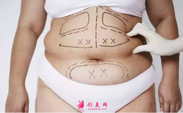 腰腹部吸脂要多久恢復(fù)好