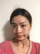 北京聯(lián)合麗格小姐姐鼻翼縮小術(shù)后效果反饋