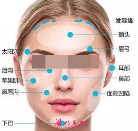 自體脂肪填充臉部效果自然嗎