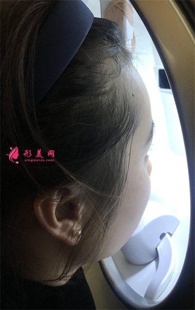 杭州皮秒激光術(shù)后恢復情況對比