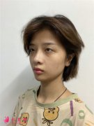 重慶華美整形眼部綜合術(shù)后恢復(fù)情況反饋