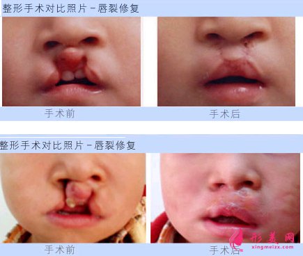 兔唇的最佳治療時間是何時?