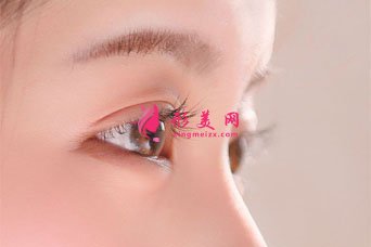 雙眼皮失敗修復大概要多少錢