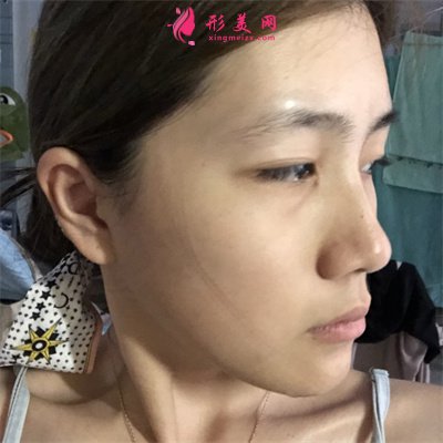 杭州小仙女齊全雙眼皮術(shù)后恢復(fù)情況對(duì)比