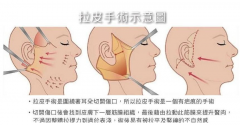 拉皮手術(shù)大概需要多少錢?大拉皮和小拉皮手術(shù)有什么區(qū)別?