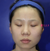上海九院下頜角+磨骨手術(shù)效果分享，擁有精致小臉不是夢(mèng)