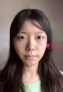 想要一雙大眼睛，在成都圣丹福整形做了眼綜合效果還不錯