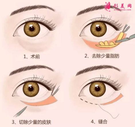 手術(shù)祛眼袋的效果怎么樣