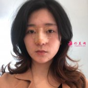 廣州曙光醫(yī)院陳鵬做鼻子怎么樣？來看看隆鼻案例~恢復(fù)護理心得