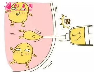 吸脂減肥的恢復(fù)期是多久