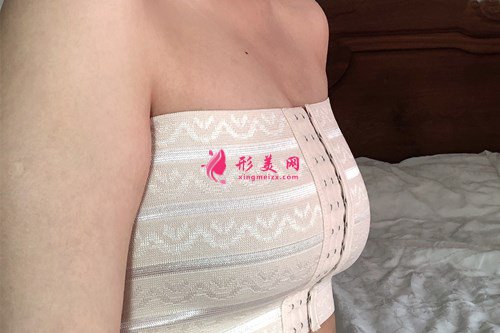廣州假體隆胸效果分享