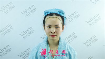 重慶種植發(fā)際線手術(shù)術(shù)后效果反饋