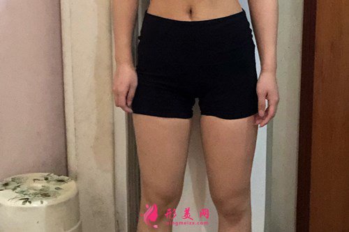 西安大腿吸脂手術(shù)后效果分享