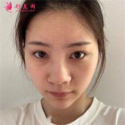深圳鵬程醫(yī)院假體隆鼻術(shù)后恢復(fù)情況反饋