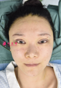 標(biāo)準(zhǔn)單眼皮也想變雙眼皮，寧波韓美美容醫(yī)院放心選擇