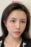 上海藝星整形醫(yī)院做個(gè)自體脂肪全臉填充怎么樣？附上案例