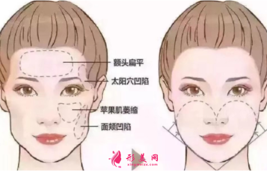 自體脂肪填充臉部后需要注意什么