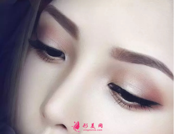 假體隆鼻術(shù)后會留下疤痕嗎