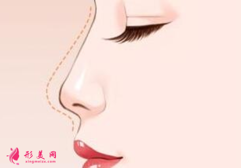 假體隆鼻術(shù)后的效果好看嗎