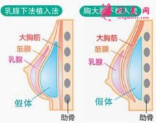 假體隆胸后會痛多長時間？