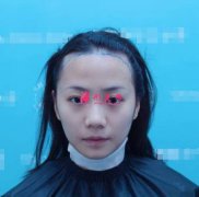 北京八大處整形醫(yī)院植發(fā)怎么樣？案例效果圖給你真實參考