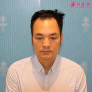 杭州新生植發(fā)醫(yī)院正規(guī)嗎？價格多少?植發(fā)案例恢復(fù)效果圖一覽
