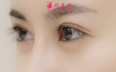切開(kāi)雙眼皮術(shù)后需要住院觀察嗎？
