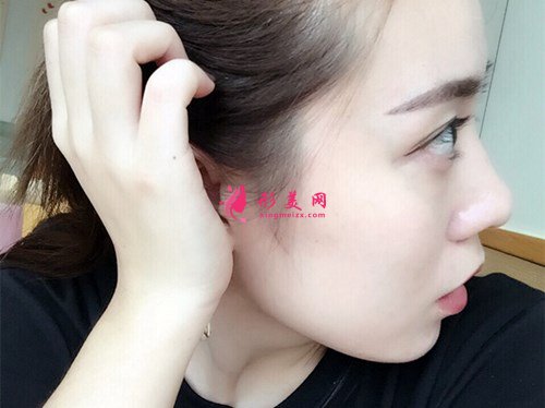 成都打玻尿酸豐面頰手術(shù)效果分享 術(shù)后 成都打玻尿酸豐面頰手術(shù)效果分享