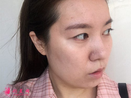 成都打玻尿酸豐面頰手術(shù)效果分享