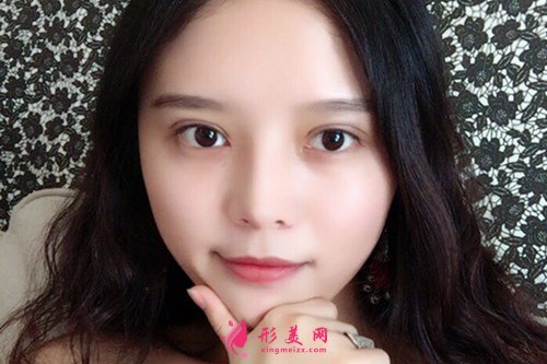 武漢全切雙眼皮效果分享 術(shù)后 武漢全切雙眼皮效果分享