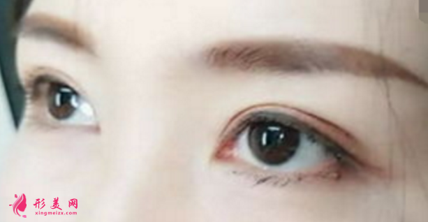 雙眼皮術(shù)后瘢痕跟什么有關(guān)