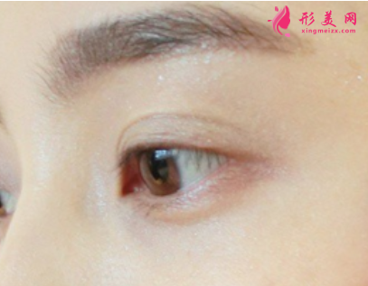 雙眼皮手術(shù)后如何消腫快
