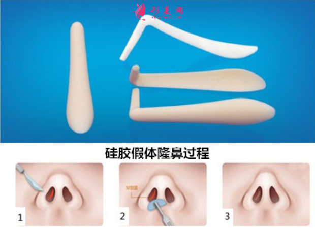 假體隆鼻松動了要取出來嗎