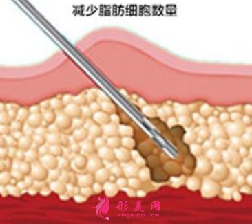 吸脂瘦身要多少錢