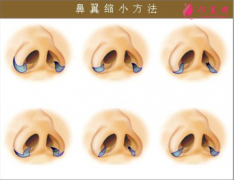 縮鼻翼手術(shù)多少錢？