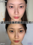 南京美貝爾黃名斗醫(yī)生眼綜合案例，這雙眼皮做的就像天生的！