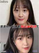 南京美貝爾黃名斗醫(yī)生雙眼皮案例，別再割歐式大平行了！