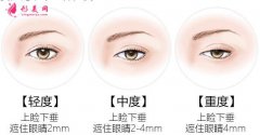 上瞼下垂矯正術(shù)后眼皮太上了怎么辦？