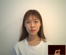 武漢新至美醫(yī)療美容醫(yī)院做雙眼皮怎么樣？來看看雙眼皮案列