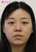 四川友誼李繼華下頜角整形手術(shù)對比照片恢復全過程分享~