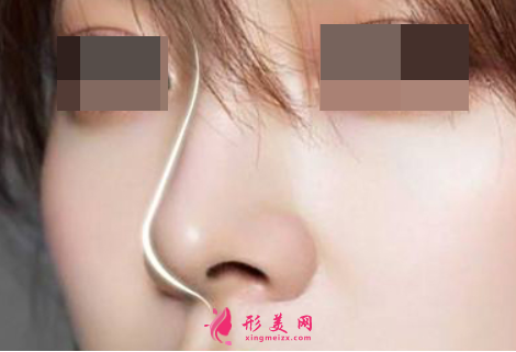 肋軟骨隆鼻后多久能恢復(fù)