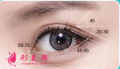 開眼角術(shù)后護(hù)理需要注意什么？