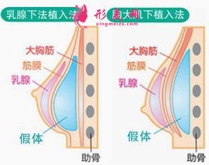 假體隆胸術適合哪些人群