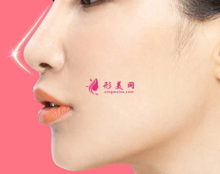 假體隆鼻術(shù)后效果可以保持多久
