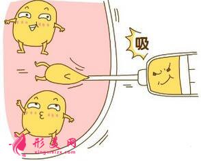 吸脂減肥什么時(shí)候可以恢復(fù)正?；顒?dòng)