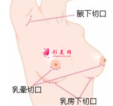 假體隆胸哪種切口好一些