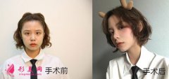 北京圣嘉新醫(yī)療美容醫(yī)院做面部吸脂如何？我也可以擁有小V臉