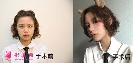 北京藝美面部吸脂案例對比圖