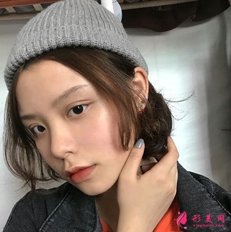 北京藝美面部吸脂案例術后1天