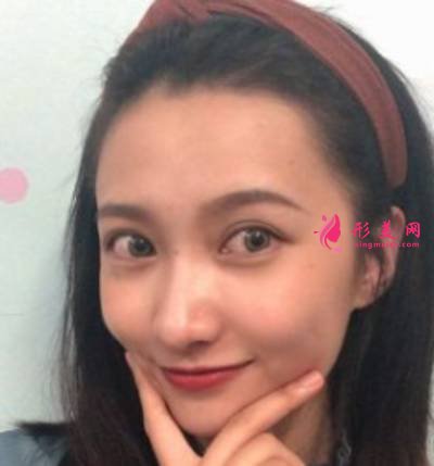 鄭州東方整形醫(yī)院雙眼皮修復(fù)案例